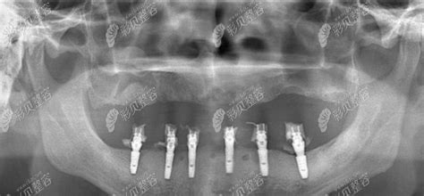 分享allon6全口种植牙的价格科普allon6的技术详细步骤和坏处 整容资讯 彩贝整容网