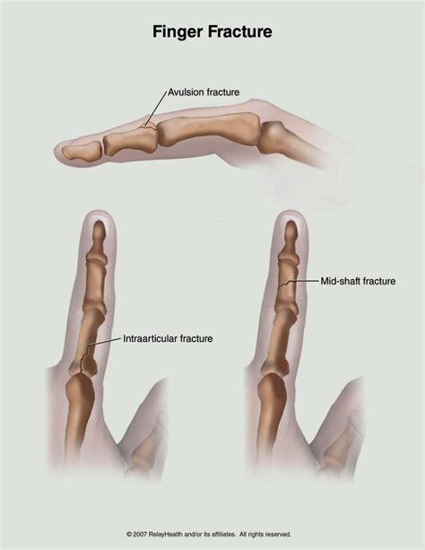 Sports Injuries: Jammed Finger