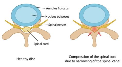 Cervical Stenosis Everything You Should Know Birla Fertility Ivf