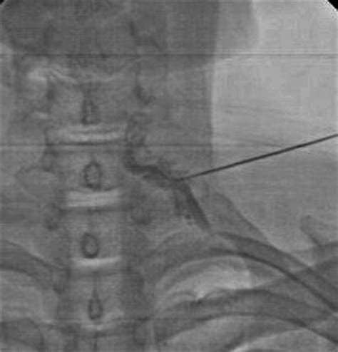 Portsmouth and Chichester Spine Surgeon | SpineInfo.co.uk | Nerve Root Sleeve Injection