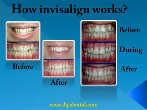 Ppt Invisalign Calgary Powerpoint Presentation Free Download Id