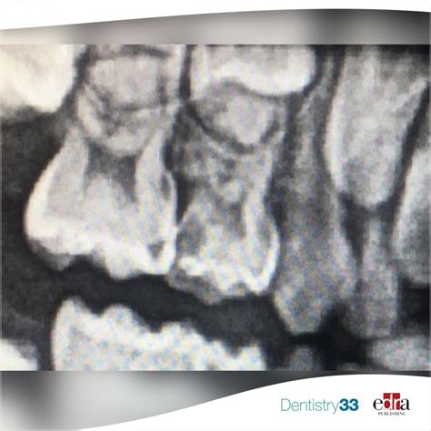 Pediatric Endodontics A Biologic Alternative To Pulpectomy Dentistry33