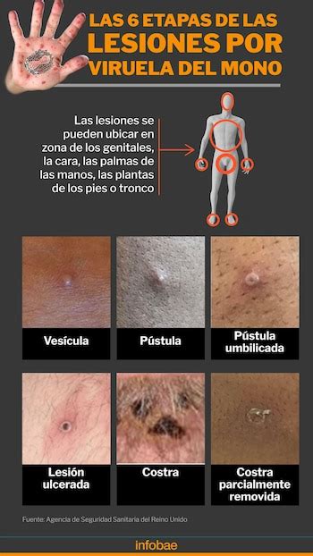 Viruela Del Mono En Argentina Cuántos Casos Del Virus Mpox Hay Y Cuáles Son Los Síntomas Para