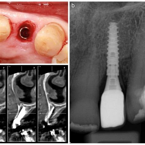 Schematic representation of a paramarginal incision. | Download ...