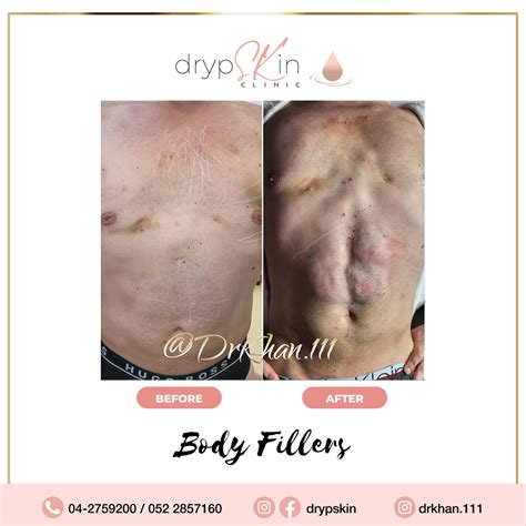 Best Butt Filler | Body Fillers Dubai | drypSKin