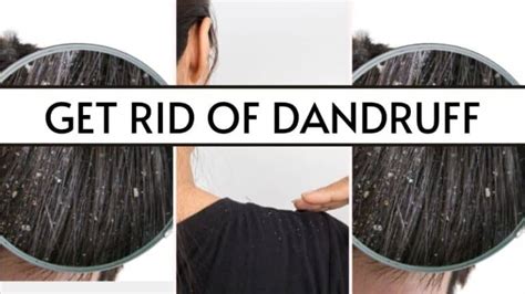 How To Get Rid Of Dandruff Naturally At Home Instant Results