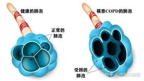 令人窒息的“慢阻肺”copd，干细胞如何有效干预？ 知乎