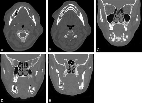 Bisphosphonate Associated Mandibular Osteonecrosis American Journal