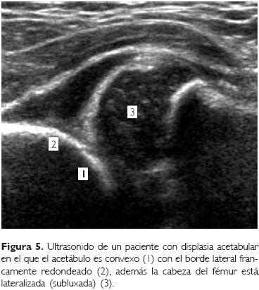 Ultrasonido ortopédico de la cadera infantil