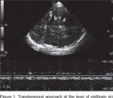 Table 1 From Screening For Chronic Cerebrospinal Venous Insufficiency Ccsvi Using Ultrasound