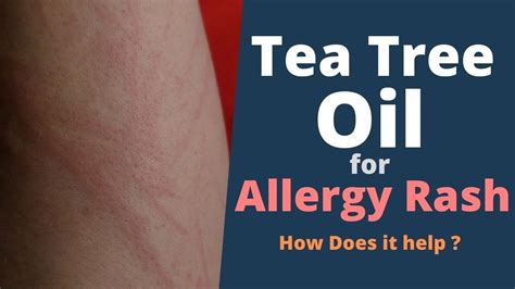 Is Tea Tree Oil Good For Allergy Rashes Youtube