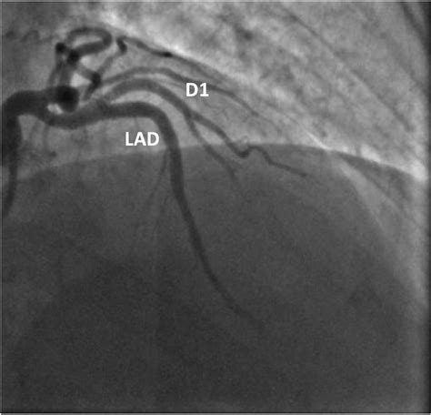 Coronary Angiogram After Stent Placement | Download Scientific Diagram