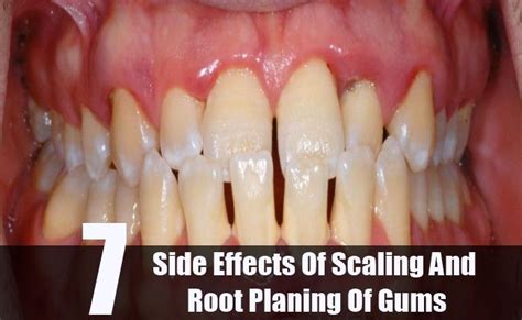 Known Side Effects Of Scaling And Root Planing Of Gums Gum Disease