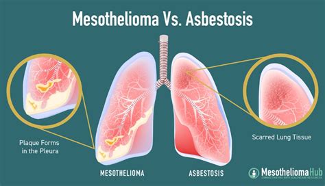 Work Related Lung Diseases Causes And Prevention Vodex