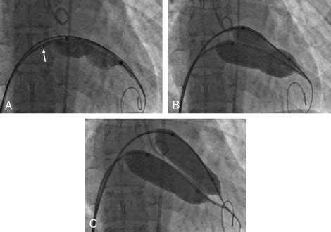 Percutaneous balloon mitral valvuloplasty | Thoracic Key