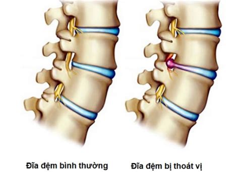 Thoát vị đĩa đệm Nguyên nhân triệu chứng chẩn đoán và điều trị Vinmec