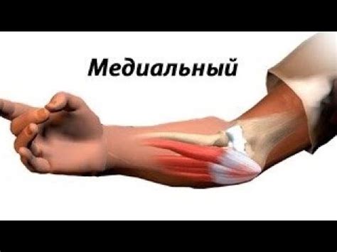 эпикондилит - полное выздоровление! - YouTube