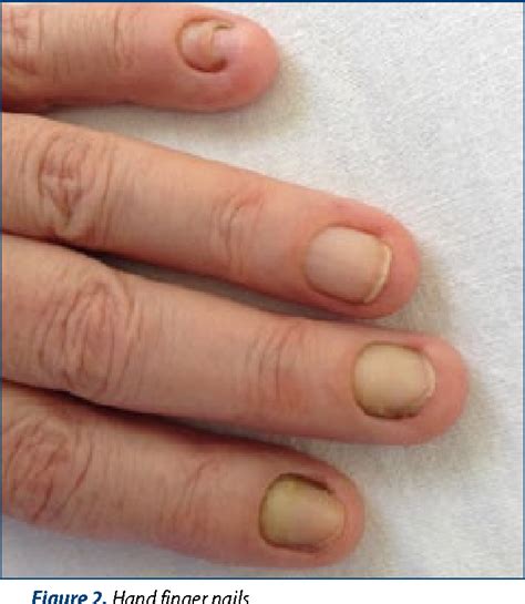 Figure 2 From A Curious Case Of Yellow Nail Syndrome Semantic Scholar