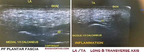 Plantar Fascia Ultrasound showing Inflammation (1) – Dr. Kapil Bakshi ...