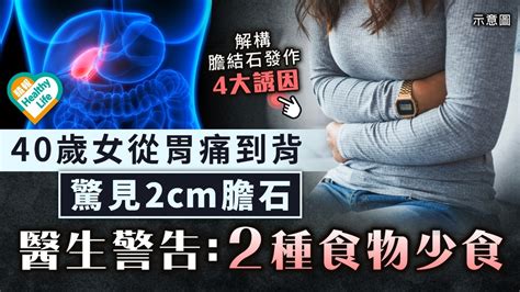 腸胃健康︳40歲女從胃痛到背 檢查驚見2cm膽結石 醫生警告：2種食物少食 晴報 健康 腸胃保健 D230220