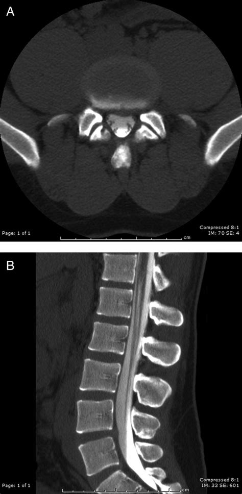 Spontaneous Resolution Of Idiopathic Lumbar Subdural Hygroma On Ct