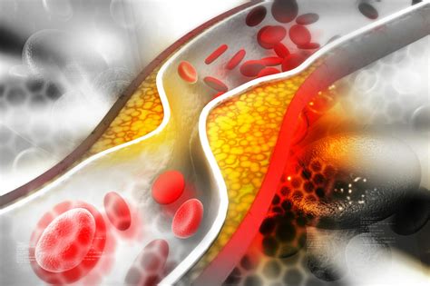 Trombosis síntomas causas prevención y tratamiento Muy Salud