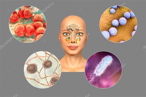 Anatom A De Rinosinusitis Y Microorganismos Que Causan Sinusitis