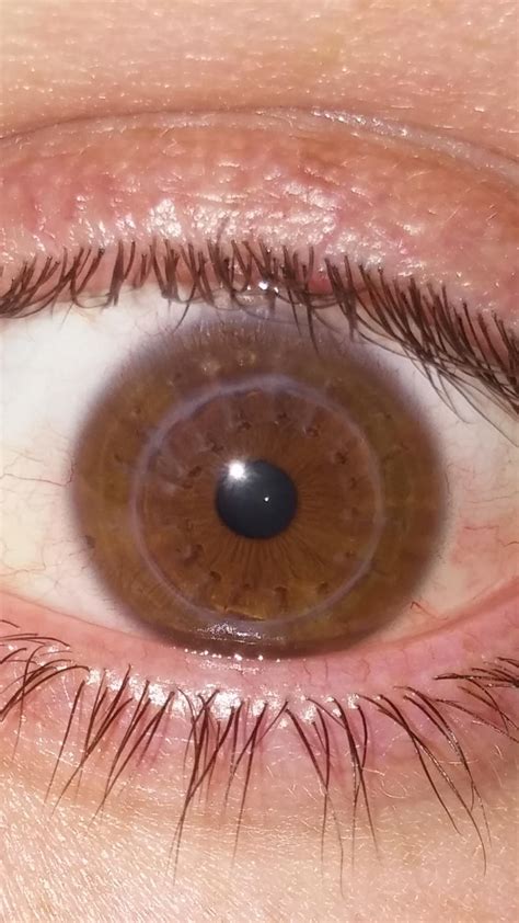 Corneal Transplant Before And After