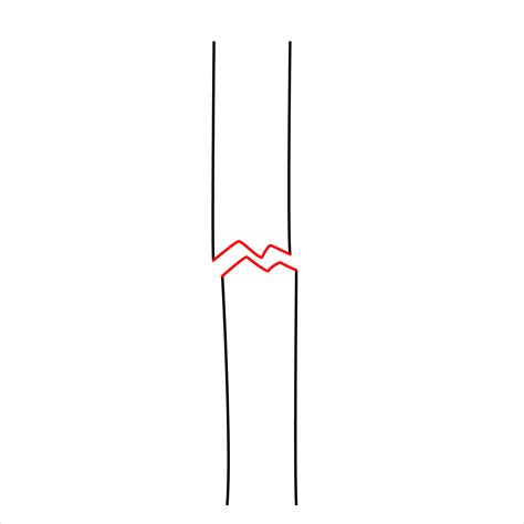 Kids Fracture System