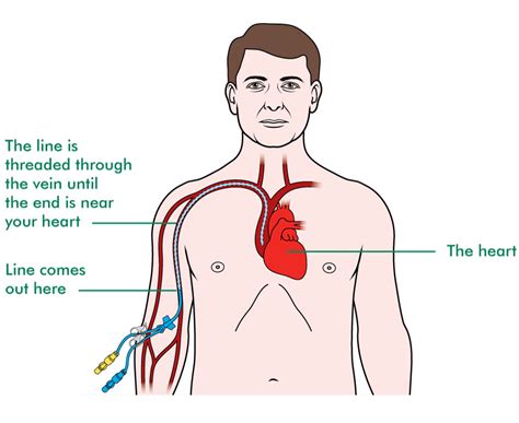 PICC Central Line Placement