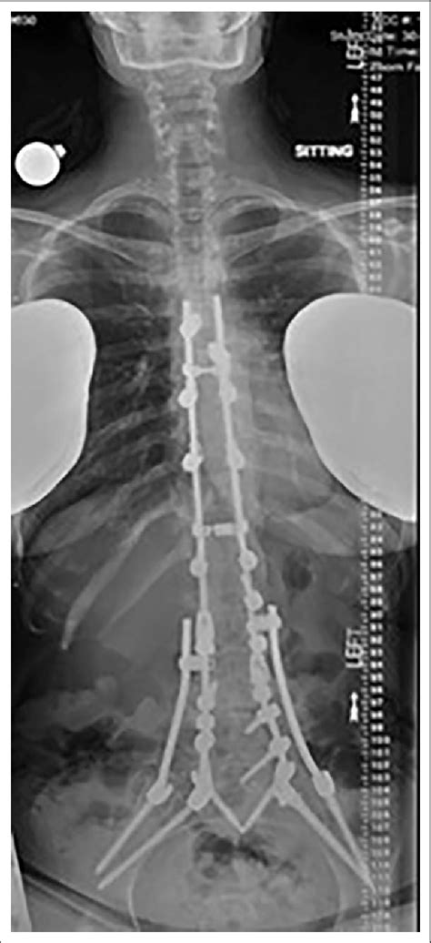 Posterior Spinal Arthrodesis Supplemented With Pelvic Fixation Download Scientific Diagram