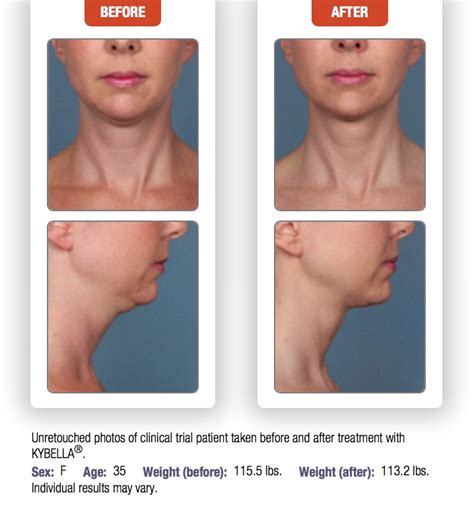 Kybella Treatments At Laser Skin Institute Chatam New Jersey