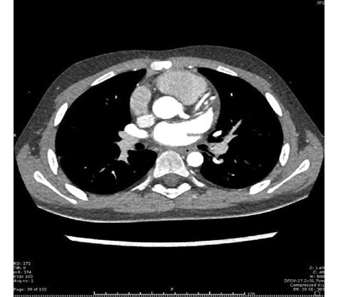 CCTA of left anterior descending (LAD) coronary artery. The LAD ...