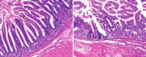 Pathology suggested intestinal mucosa is attached to the smooth muscle ...