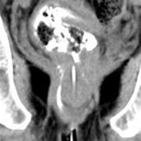 Inter Sphincteric Tract With A Supralevator Extension Suggesting A