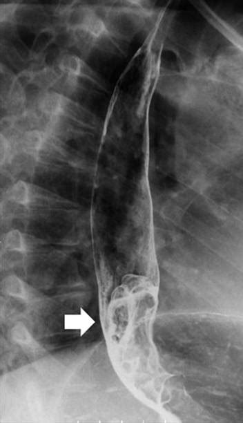 Barium Esophagogram Study Shows A Type 2 Tumor Located In The Lower