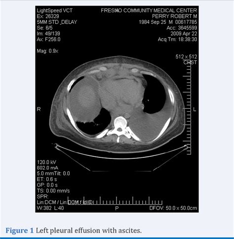 Figure 1 From A Rare Case Of Pleural Effusion Burkitt S Lymphoma With