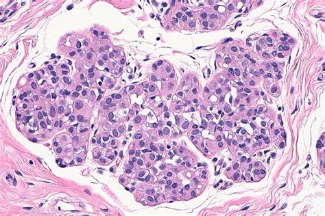 Atypical Lobular Hyperplasia Libre Pathology