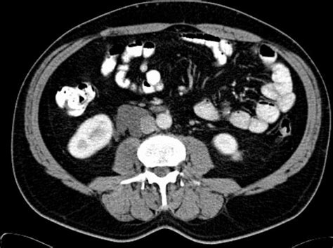 Infected Retroperitoneal Cystic Lymphangioma A Case Report Eurorad