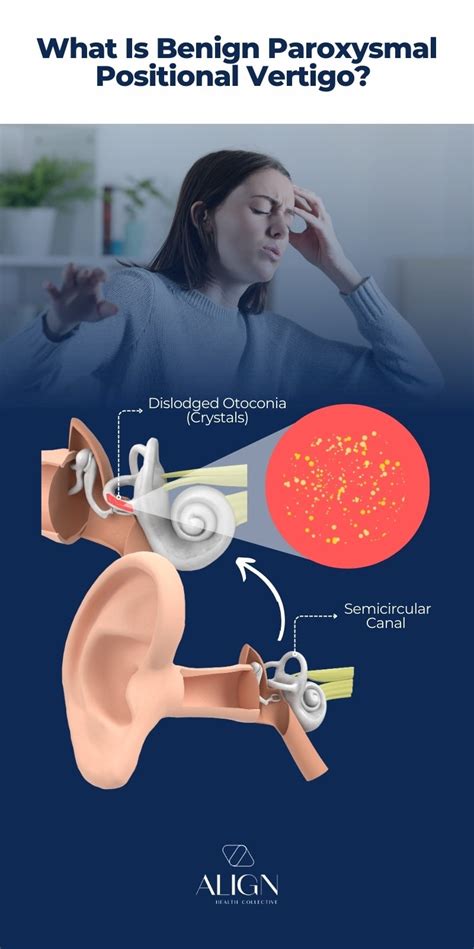 Benign Paroxysmal Positional Vertigo Bppv Physiotherapy