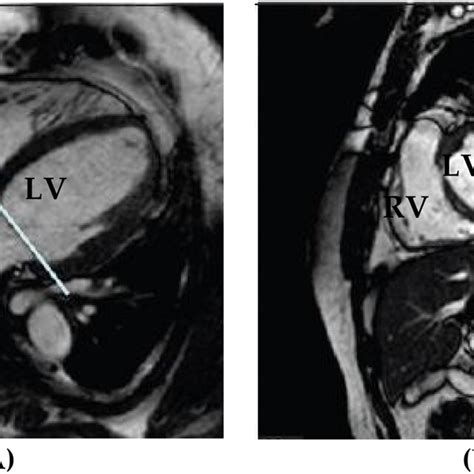 Cardiac MRI In Diastolic Phase A Long Axis Slice B Short Axis