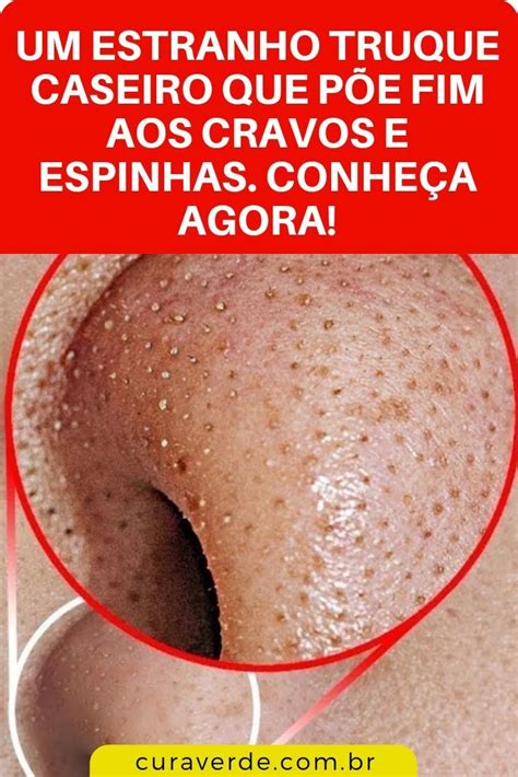 Como Remover Cravos E Espinhas Em Apenas Minutos Cravos E Espinhas