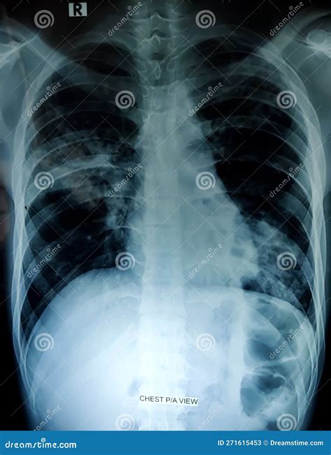 Chest X Ray Pa View Show Suggestive Of Bilateral Pneumonitis Or Ptb