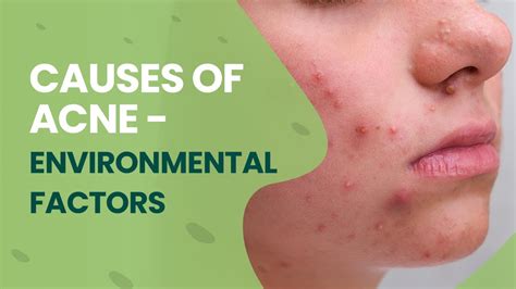 What are the Main Causes of Acne - Acnewiki