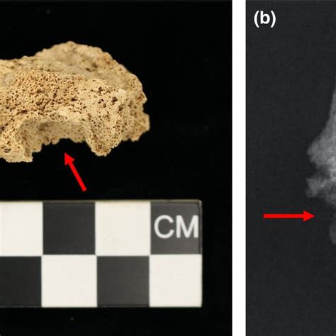 Photograph A And Radiograph B Of Lytic Lesion Observed On The Download Scientific Diagram