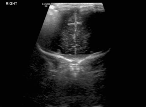 Grade Iv Germinal Matrix Hemorrhage With Periventricular Leukomalacia