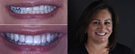 Before After Smile Makeover Gallery