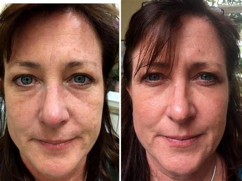 Vampire Facelift Before And After