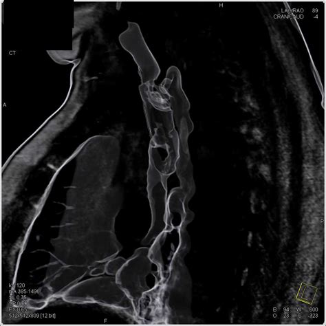 Stent In Trachea In 3d With Tracheal Stenosis Chest Case Studies