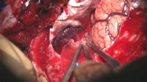 Cavernous Sinus Meningioma With Orbital Involvement The Couldwell